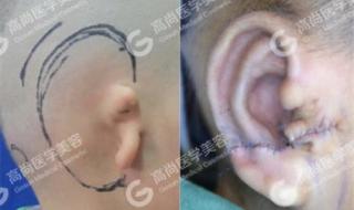 耳朵修复手术多少钱啊 耳朵修复手术多少钱啊